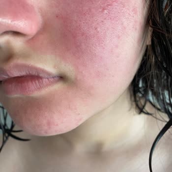 Neutrogena Canlandırıcı Günlük Peeling Jel Alerji Yaptı Yaktı Yüzü