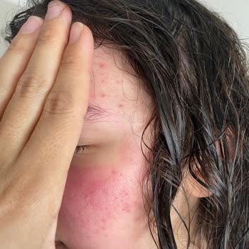 Neutrogena Canlandırıcı Günlük Peeling Jel Alerji Yaptı Yaktı Yüzü