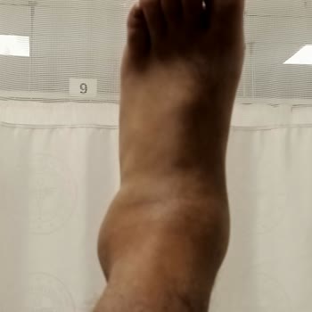 Gölbaşı Belediyesi İhmal Sonucu Ağır Yaralanmalı Kaza