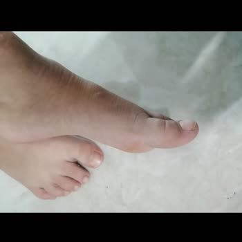 Skechers Twisty İce Yara Yaptı Nasır Dedi Doktor Ayakkabı Dan Dedi