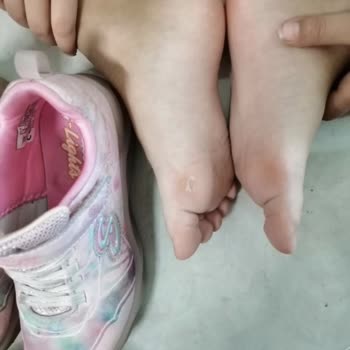 Skechers Twisty İce Yara Yaptı Nasır Dedi Doktor Ayakkabı Dan Dedi