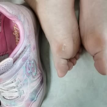 Skechers Twisty İce Yara Yaptı Nasır Dedi Doktor Ayakkabı Dan Dedi