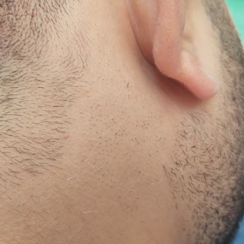 Doruk Tıp Merkezi Siyah Kıllar Beyaz Oldu