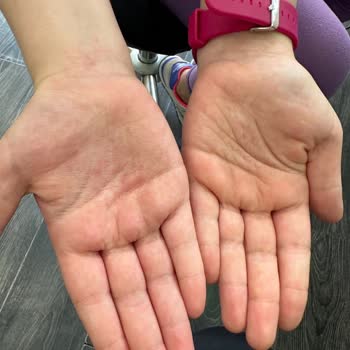 Tereson Ter Sonunu Değil Cilt Sorunu Yarattı