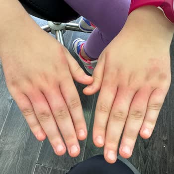 Tereson Ter Sonunu Değil Cilt Sorunu Yarattı