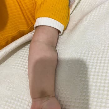 Rumeli Hospital Hastane, Hemşire Sağlık, Damar Yolu Bulma!