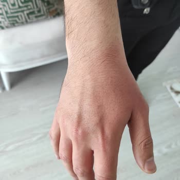 Stanley Termos Elimde Patladı