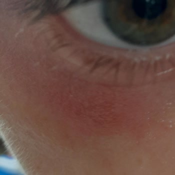 Dove Kuruluk Ve Sivilce Yapıyor!