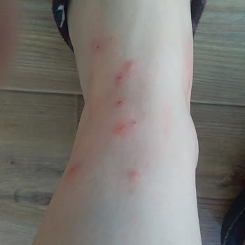 Herbalife Ayaklarımı Yara Yaptı