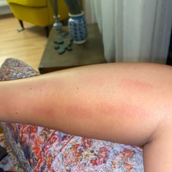 Philips Lumea IPL Lazer