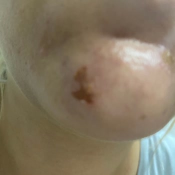 Vivet Tüy Sarartıcı Yüzümü Yaktı