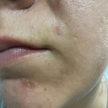 Vivet Tüy Sarartıcı Yüzümü Yaktı