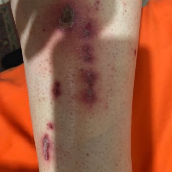 Philips Lumea Prestige BRı950 Burnt My Leg