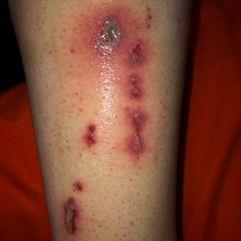 Philips Lumea Prestige BRı950 Burnt My Leg