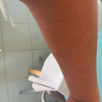 Eda Taşpınar'ın Bronzlaştırıcı Yağı Kaşıntı Yapıyor