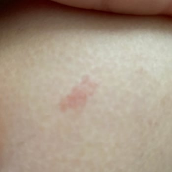 Tac Mahal Estetik (Samsun) Lazer Sonrası Ciltte Yanıklar