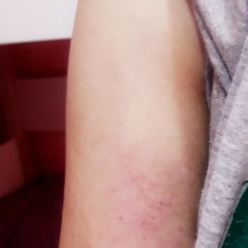 Sesu Roll-on Sir Ağda Cildime Zarar Veriyor