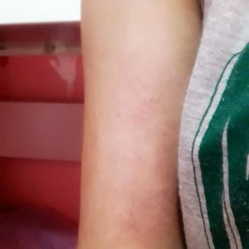 Sesu Roll-on Sir Ağda Cildime Zarar Veriyor