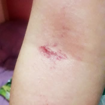 Sesu Roll-on Sir Ağda Cildime Zarar Veriyor