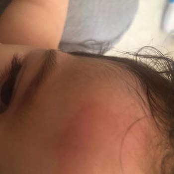 Mustela Arnica Jel Alerji Yaptı