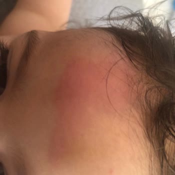 Mustela Arnica Jel Alerji Yaptı
