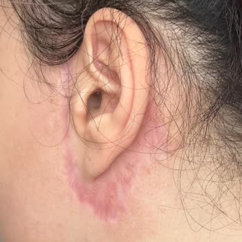 Nara Clinique Yüz Germe Ameliyatında Tehlike