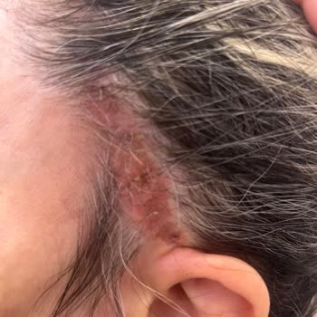 Nara Clinique Yüz Germe Ameliyatında Tehlike