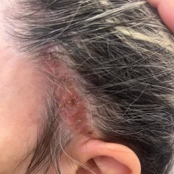 Nara Clinique Yüz Germe Ameliyatında Tehlike