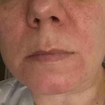 Bioten Detoks Yüz Maskesi Alerji Yaptı