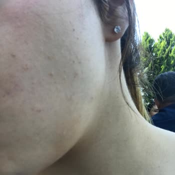 Yves Rocher Tonik Ve Yıkama Jeli Tahriş Etmesi