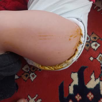 Sızdıran Purebaby Bebek Bezi