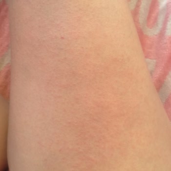 Gratis Cilt Reaksiyonu Gösteren Krem