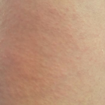 Gratis Cilt Reaksiyonu Gösteren Krem