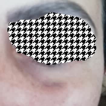 Dr. Mustafa Ekmen Klinikte Botox Mezoterapi Uygulaması Zarar Verdi!