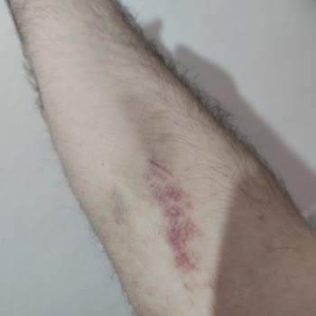 Türk Kızılay Kızılay Kan Verme Sonrası Morarma