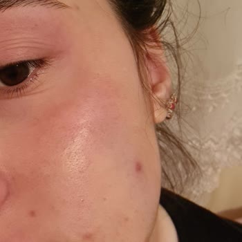 La Roche - Posay Effaclar Duo Kremi Yüzümü Yaktı