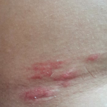 Fantasia Hotel De Luxe Kuşadası Hijyen Sorunundan Dolayı Enfeksiyon Kaptım!