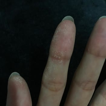 Palette Eldiven Kullanmama Rağmen Ellerimde Beyazlıklar Oluştu