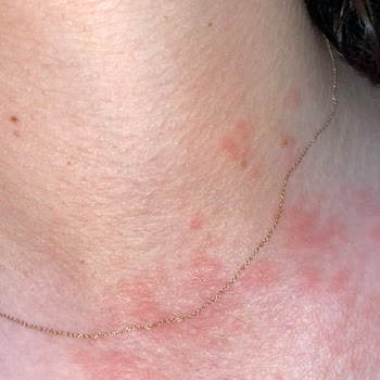 Eda Taşpınar Intense Bronzing Yağı Kullanımı Sonrası Ciltte Kızarıklık Ve Şişme