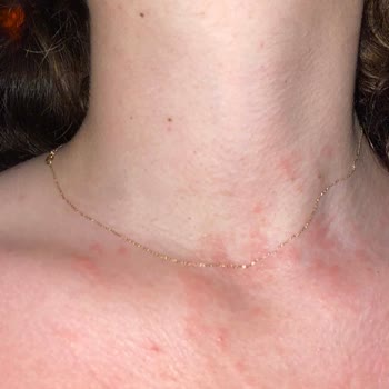 Eda Taşpınar Intense Bronzing Yağı Kullanımı Sonrası Ciltte Kızarıklık Ve Şişme