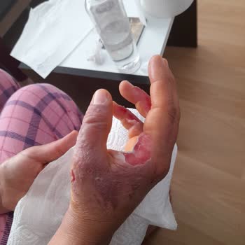 BİM Lavabo Açıcı Elimi Yaktı