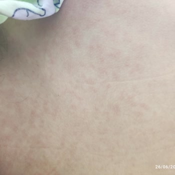 Mustela Güneş Kremi Alerji Yaptı