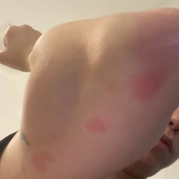 Yves Rocher Vanilyalı Vücut Sütü Kullanımında Kabarma Ve Kaşıntı