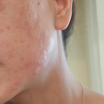 Neutrogena Yüzümü Yakan Maskesi