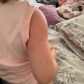 Cire Aseptine Kalitesizlik Ve Alerji