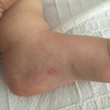 FLO Vicco Ayakkabı Çocuklarımın Ayaklarını Yaraladı