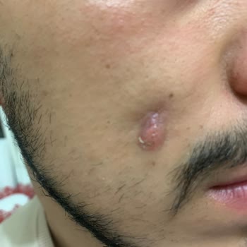 Rami Hastanesi Doktor Hatası Yüzünden Yüzüm Eskisi Gibi Değil