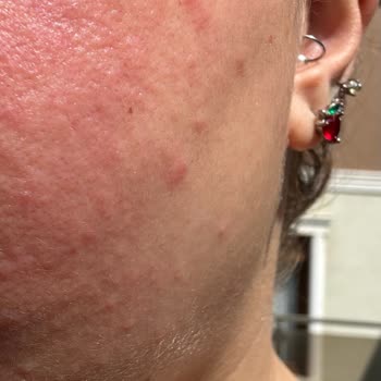 Kiperin Collagen Kiperin Kolajen Sivilce Çıkarıyor