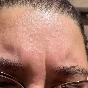 Kiperin Collagen Kiperin Kolajen Sivilce Çıkarıyor