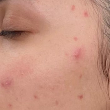 Kiperin Collagen Kiperin Kolajen Sivilce Çıkarıyor